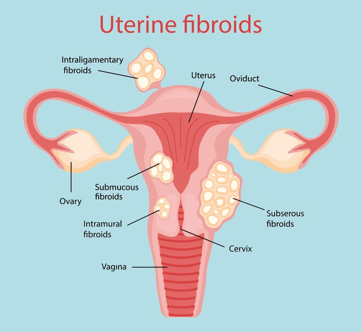 diagram of types of uterine fibroids