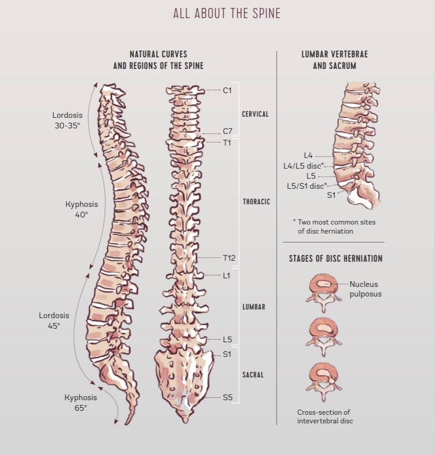 Infographic showing the anatomy of the spine and stages of disc herniation